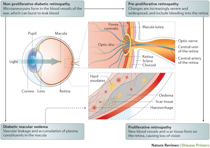 Diabetic Retinopathy