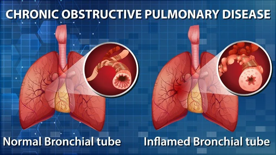 Chronic Obstructive Pulmonary Disease (COPD)