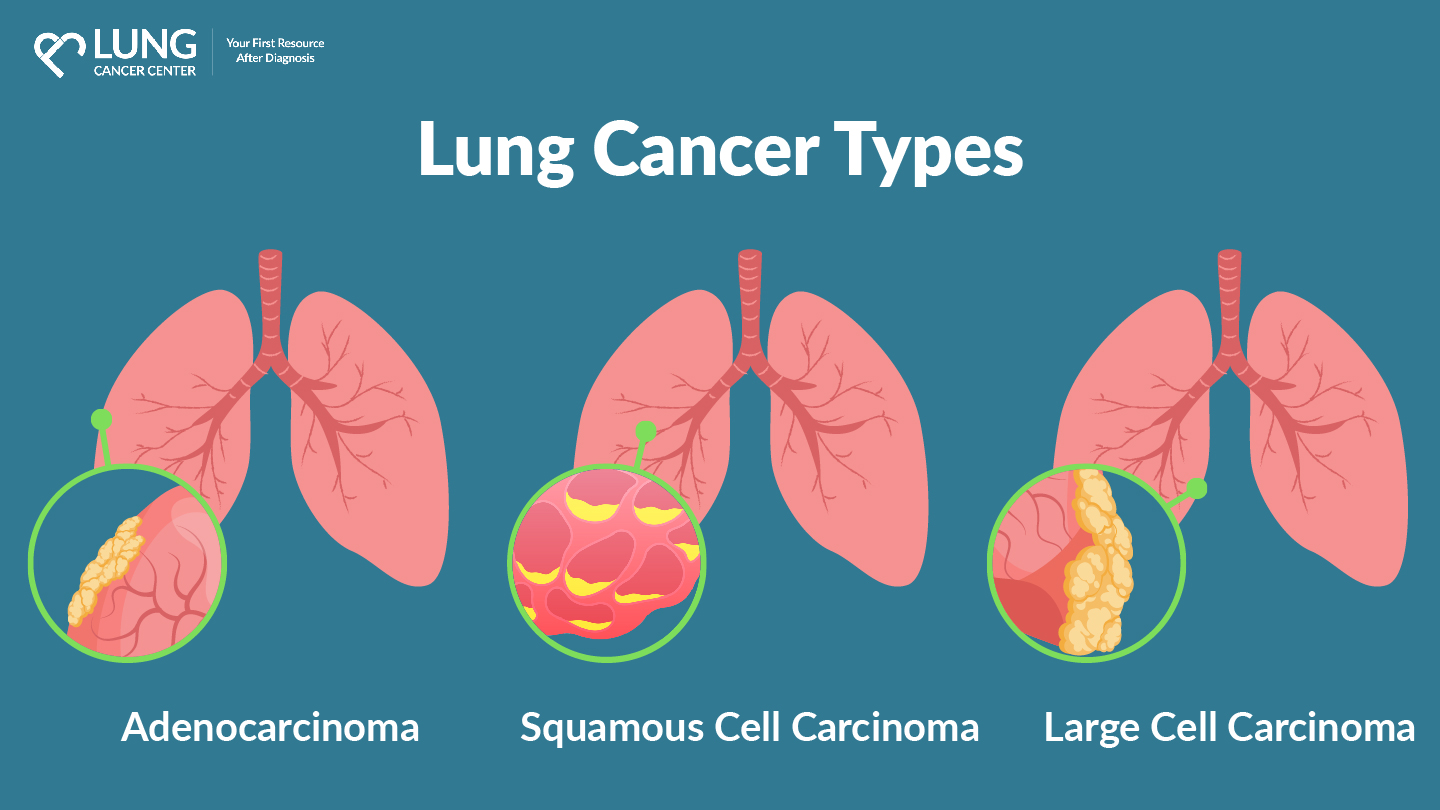 Lung Cancer