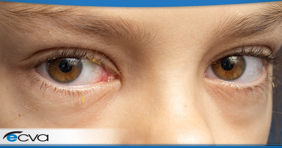 Conjunctivitis (Pink Eye)